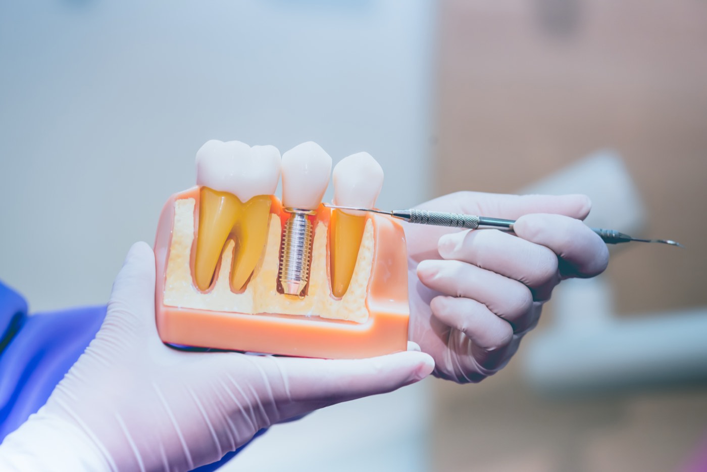 Dental Implants