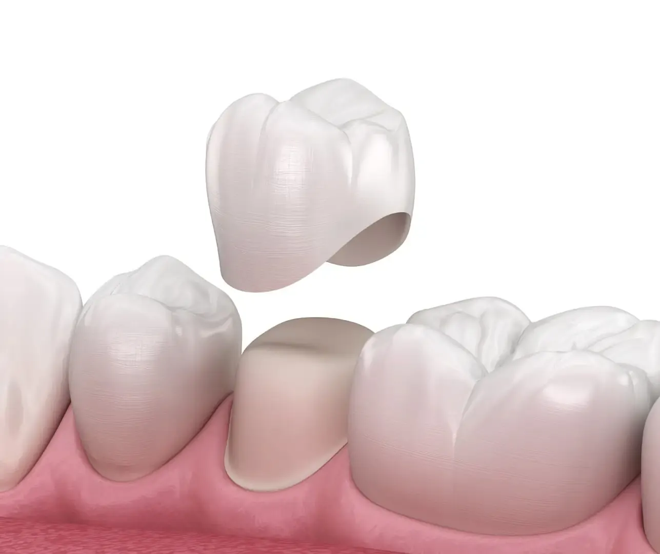 Tooth Repair & Restoration
