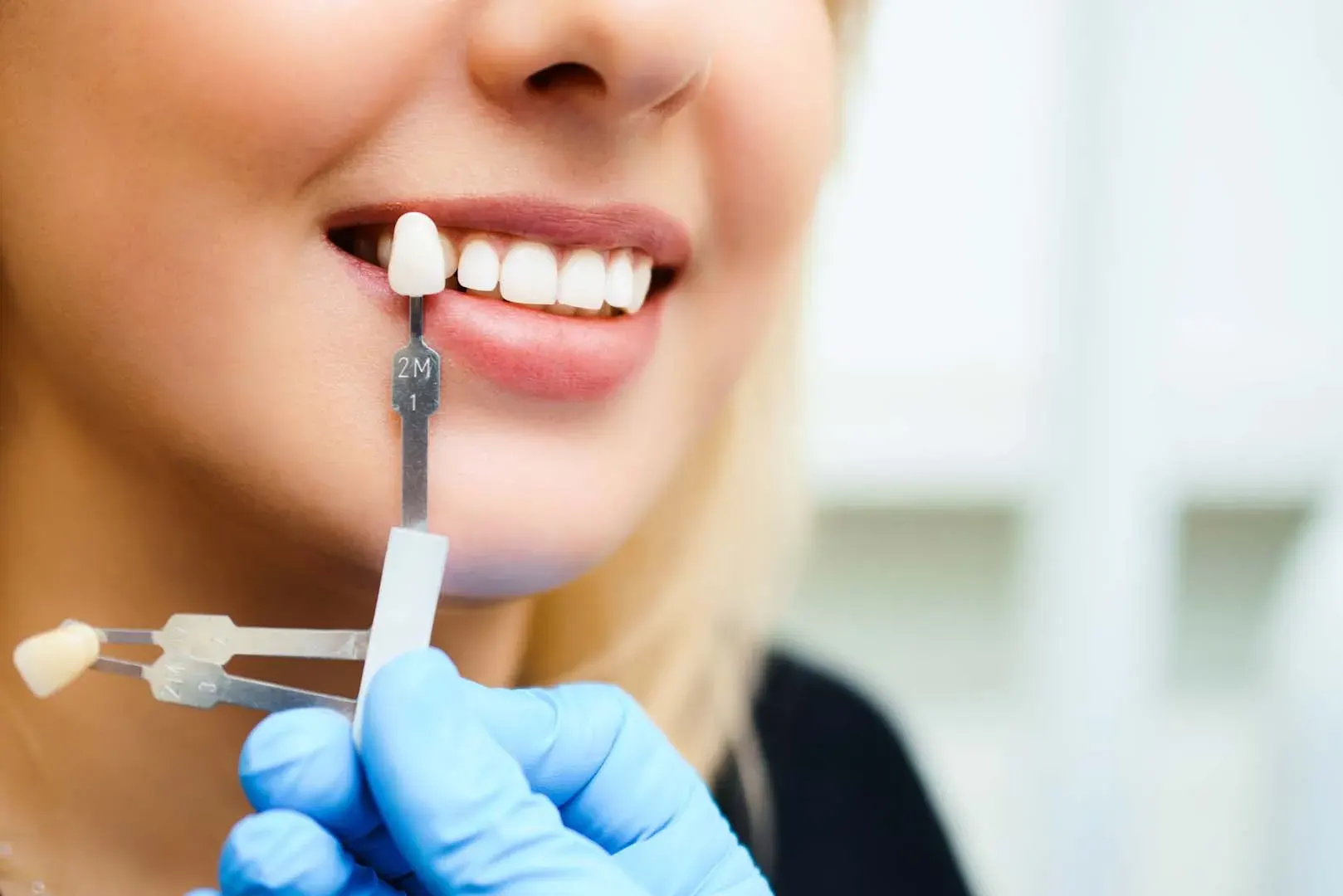 Porcelain Veneers at Clark Dental