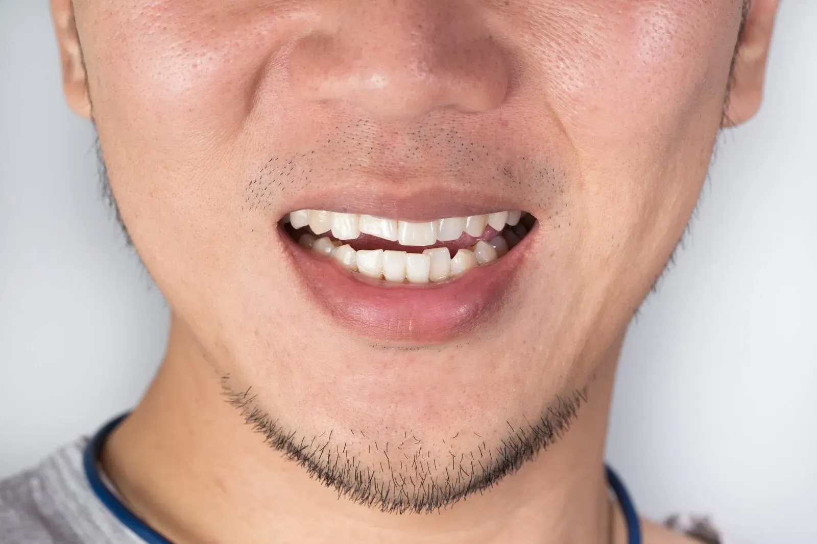 Traumatic Injuries at Clark Dental in Salisbury, NC
