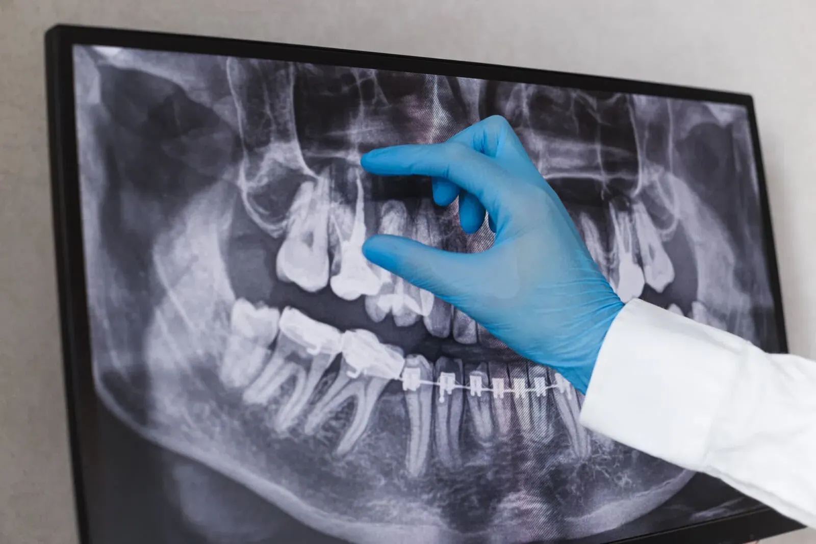 Endodontics at Clark Dental