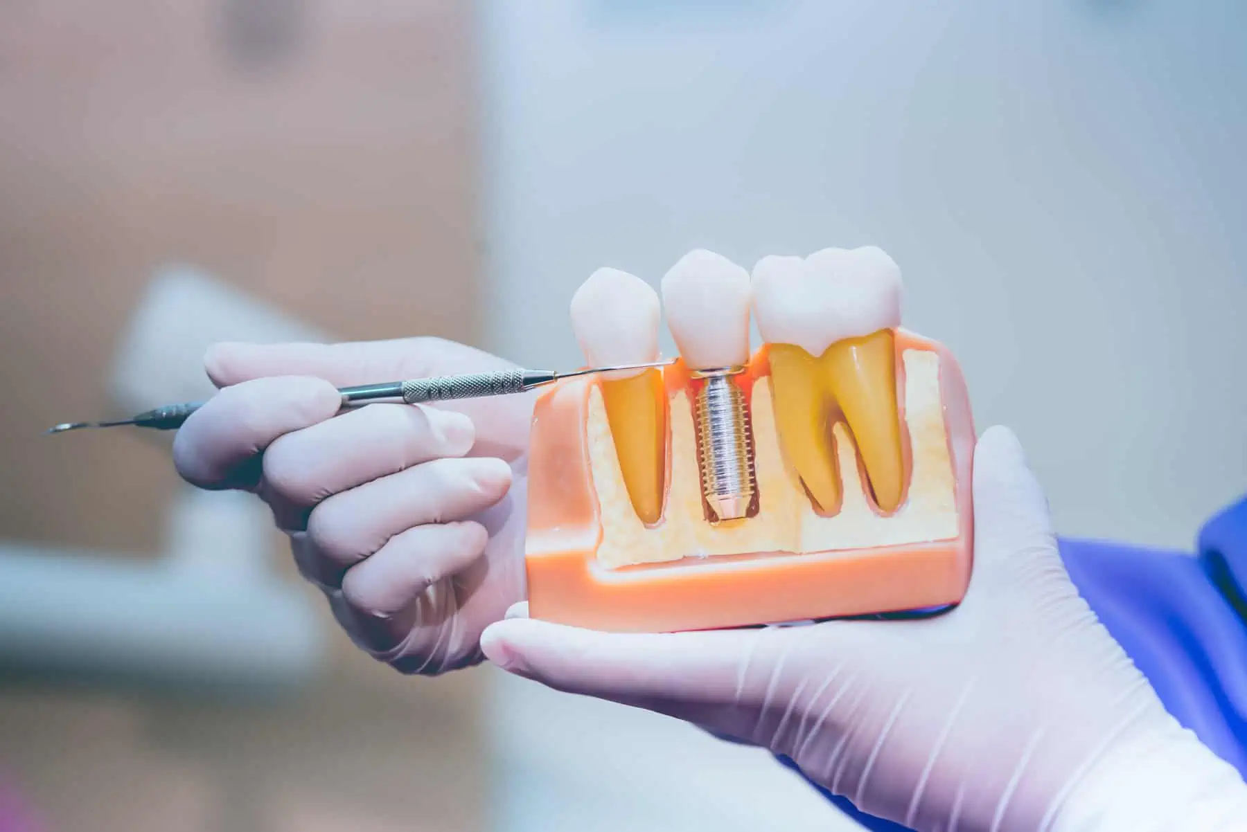 Dental Implants at Clark Dental