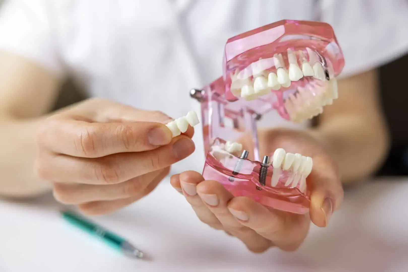 Bridges at Clark Dental
