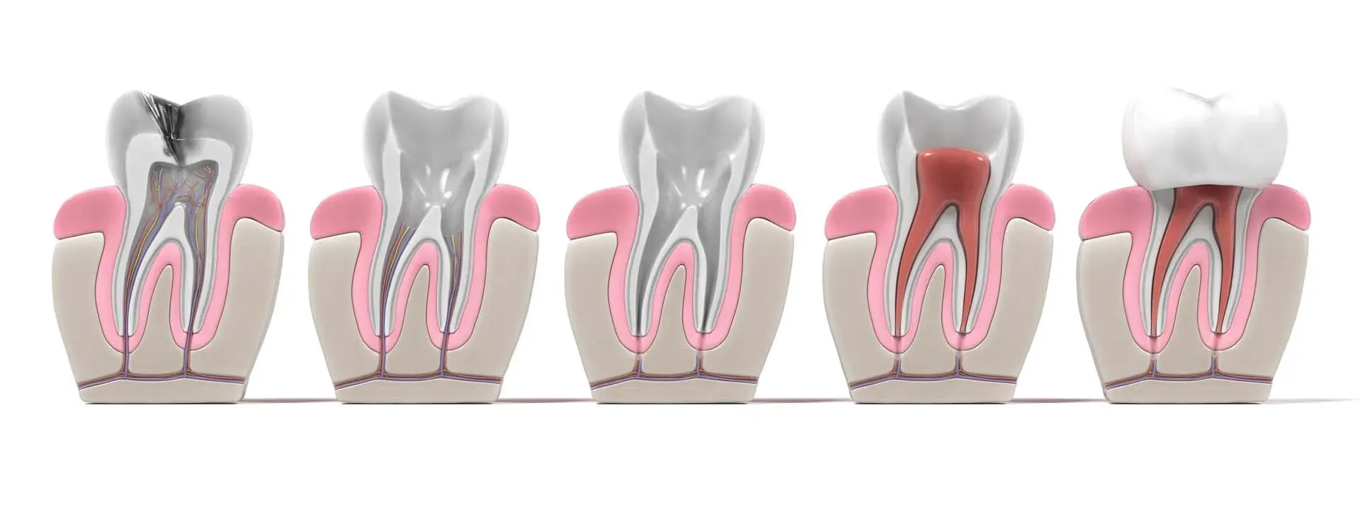 Root Canals at Clark Dental in Salisbury, NC